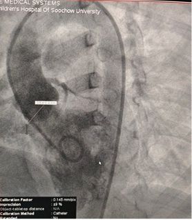 Case Sharing | Successful Closure of Multi-Exit Membranous Septal Aneurysm-Type VSD Using MemoSorb Biodegradable Occluder
