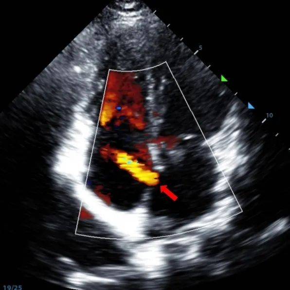 2-Year Follow-Up | MemoSorb Biodegradable ASD Occluder