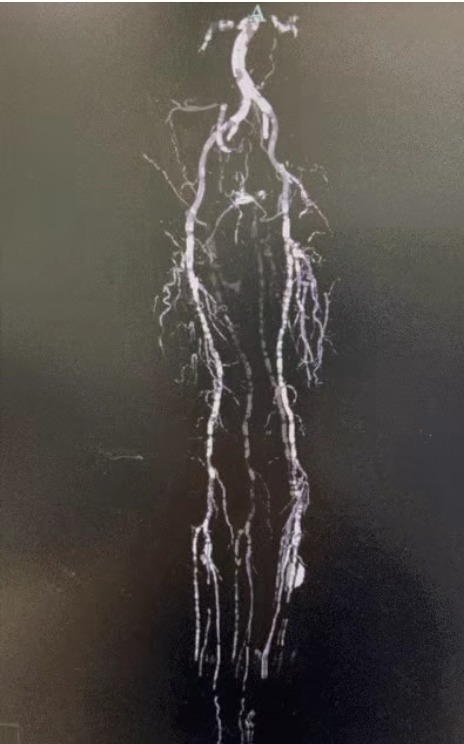 Case Sharing | Severe Lower Limb Arterial Calcification Treated with ThorCrack Peripheral IVL