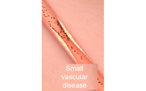 fanyiStent Restenosis Small Vascular Disease